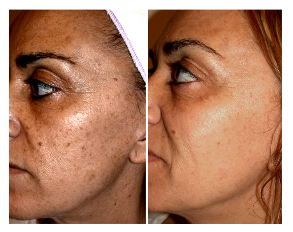 Photofacials - sun damaged skin is reversed with a series of 3-6 treatments and home care of a melanin suppressant.